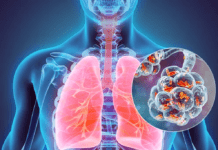 Neumonía: la vacuna es clave ante la principal causa global de muerte infantil por infección