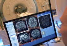 Estudio Revela Prolongadas Secuelas Cerebrales en Ex Atletas Retirados